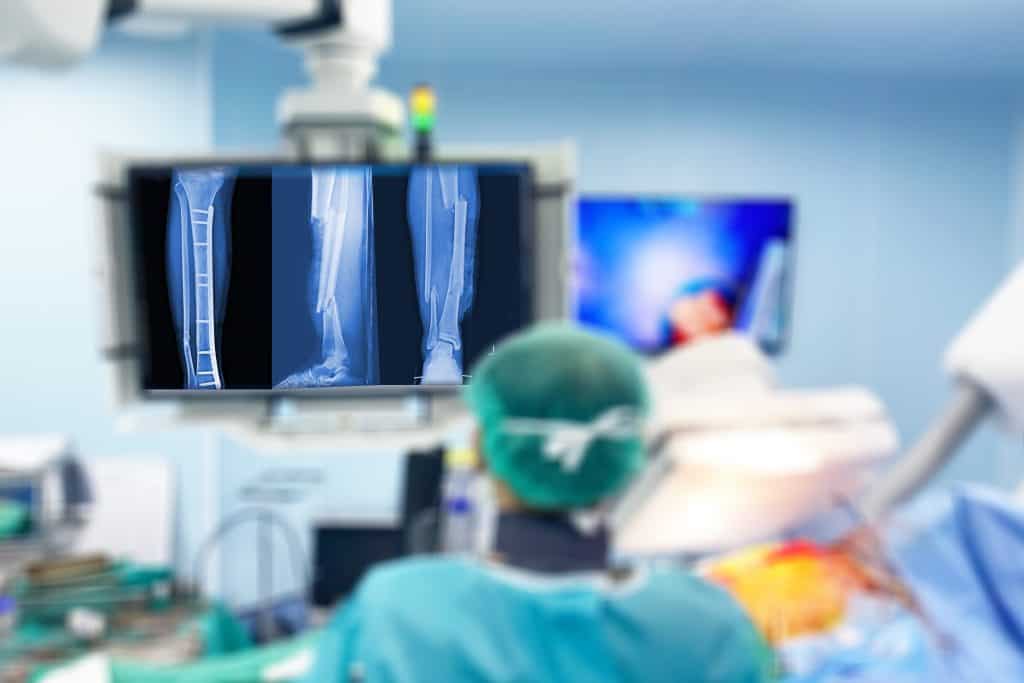 Fracture treatment in Alexandria